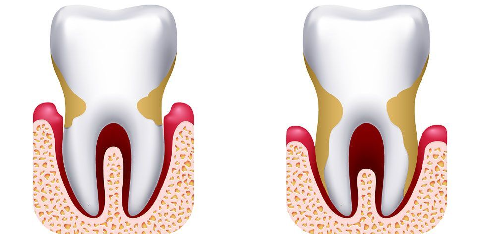 Periodontal treatment: What everyone needs to know? - SDC clinic