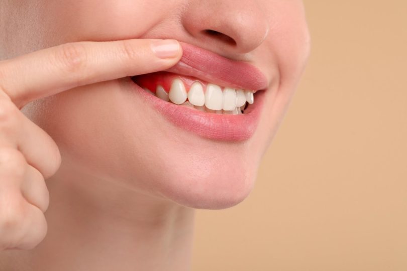 Dantų įtrūkimai: kaip juos pastebėti, kol problema netapo rimta?