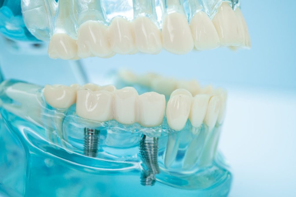 Dantų implantų prigijimas: kiek trunka gijimas ir kada sunerimti?