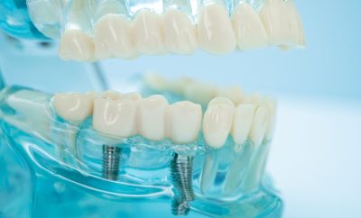 Dantų implantų prigijimas: kiek trunka gijimas ir kada sunerimti?